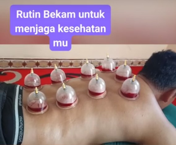 terapi bekam sunnah banyuwangi, gus adi islahdiri